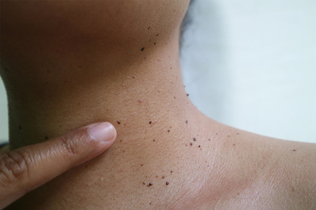 What-You-Need-to-Know-About-Skin-Tags-and-Skin-Tag-Removal
